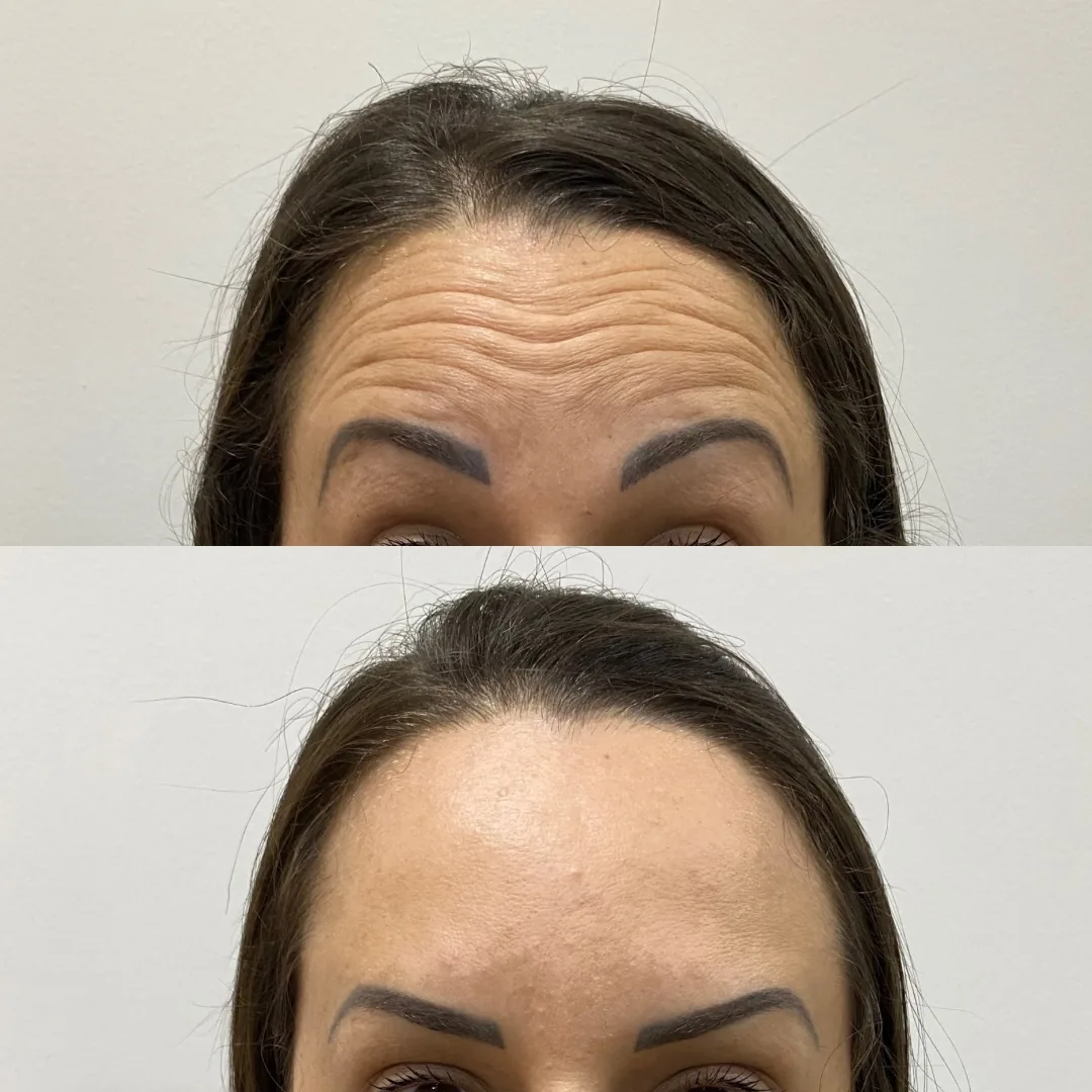 Botox - Pommerdent