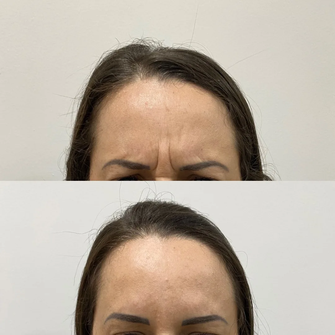 Botox - Pommerdent