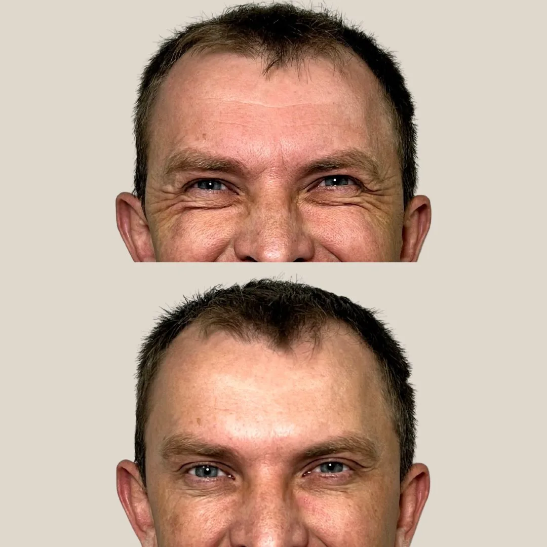 Botox - Pommerdent