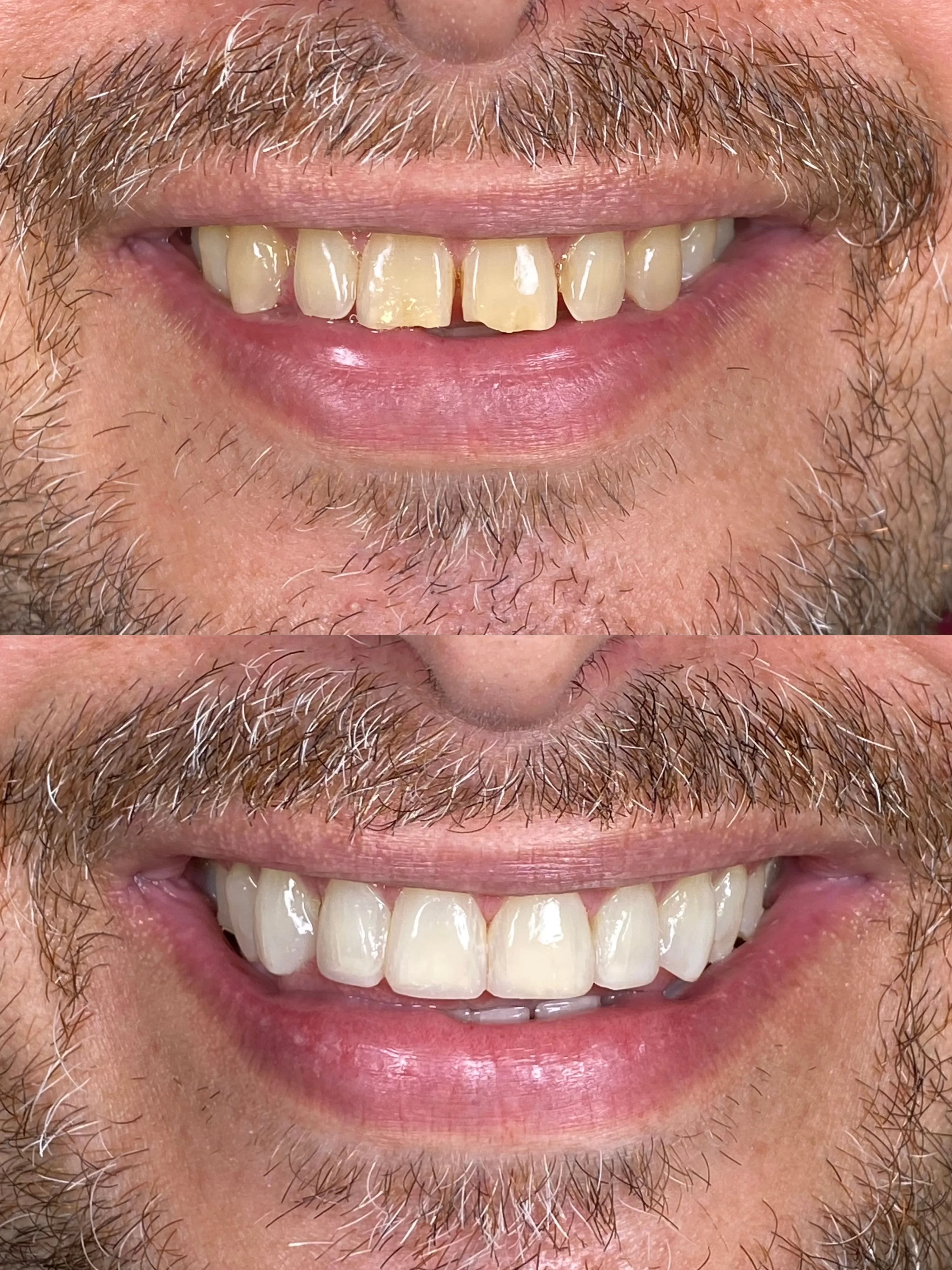 Transformação com facetas - Pommerdent