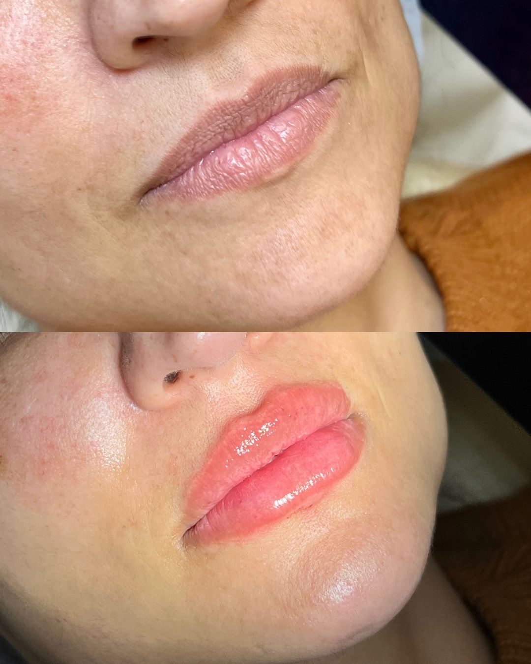 Harmonização Facial