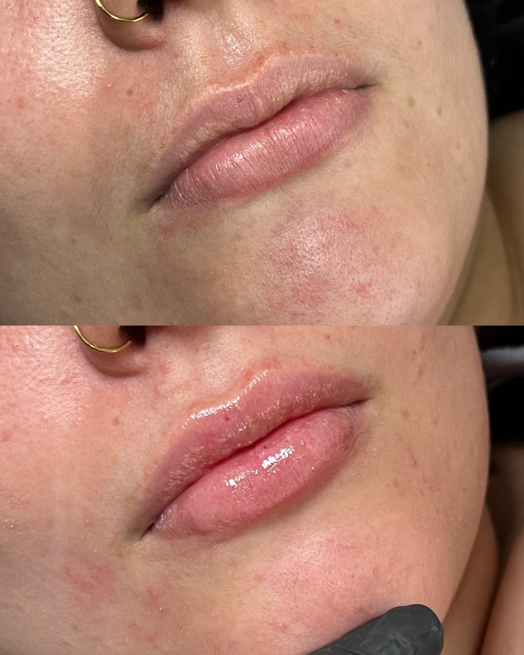 Harmonização Facial