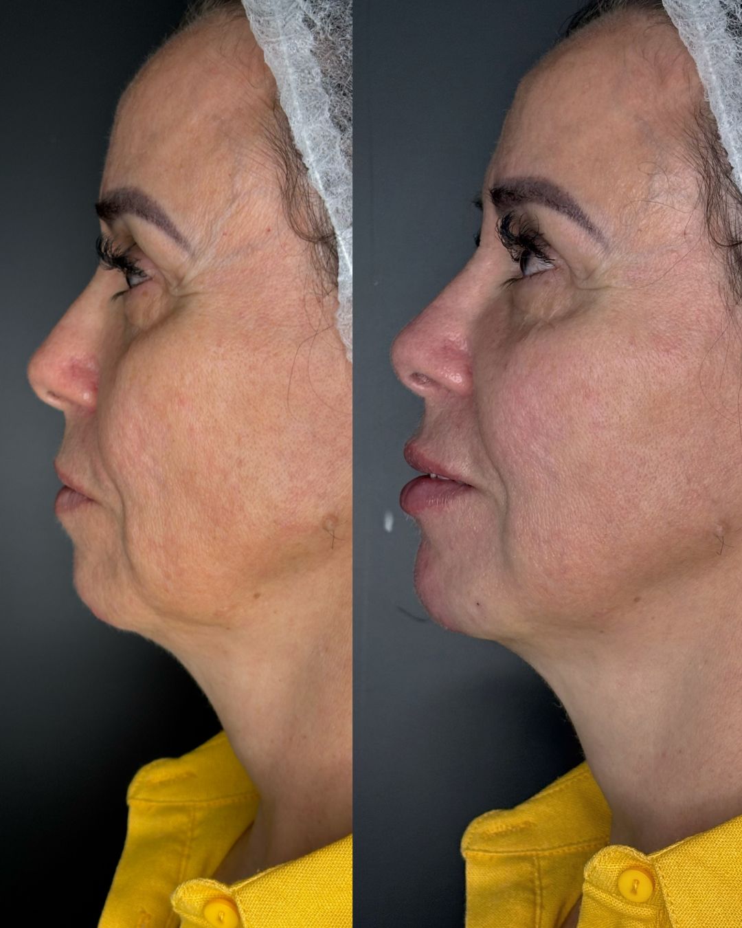 Preenchimento Labial e Mento