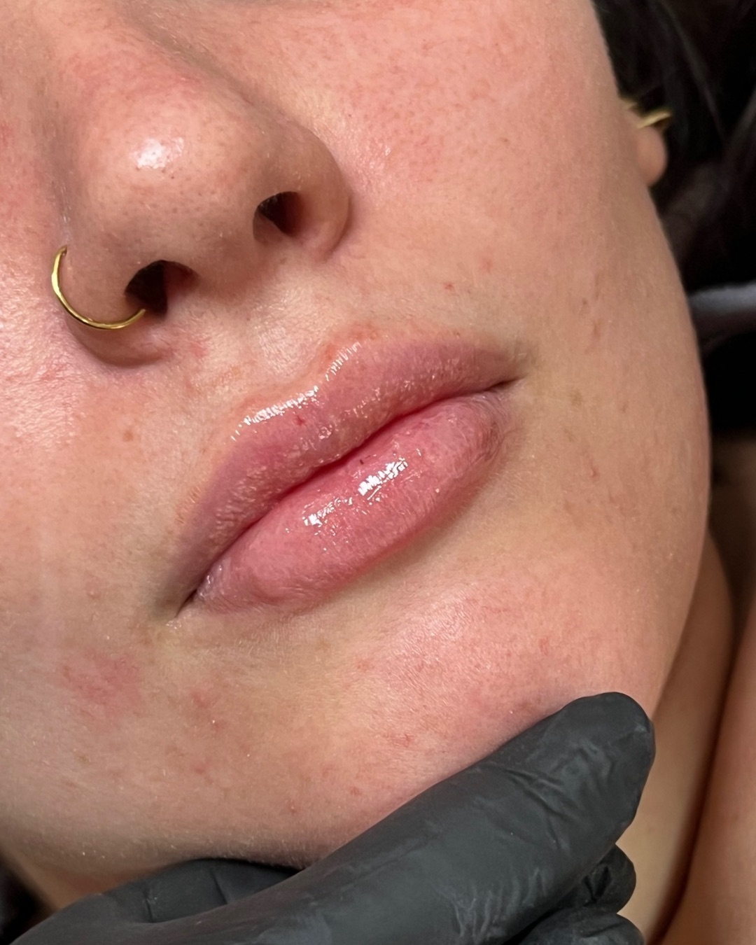 Preenchimento Labial