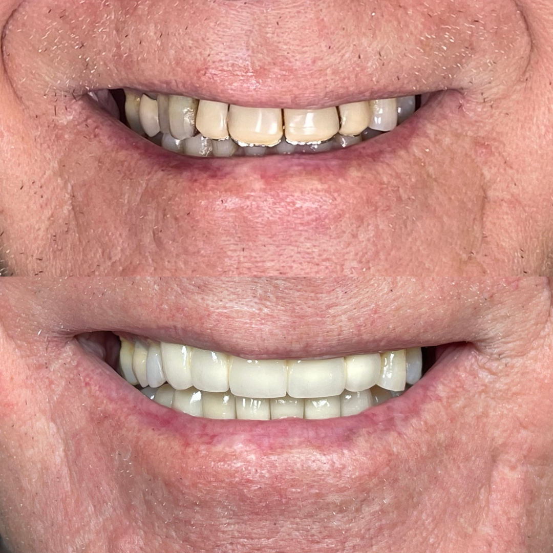 Reabilitação Oral - Pommerdent