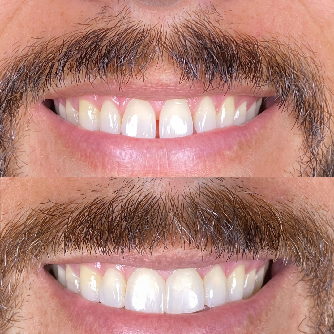 Harmonização Dental Resina